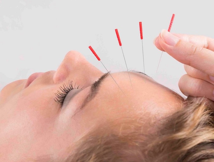 einseitige kopfschmerzen kopfschmerzen arten was hilft gegen migräne einseitige kopfschmerzen akupunktur machen tipps gegen kopfschmerzen