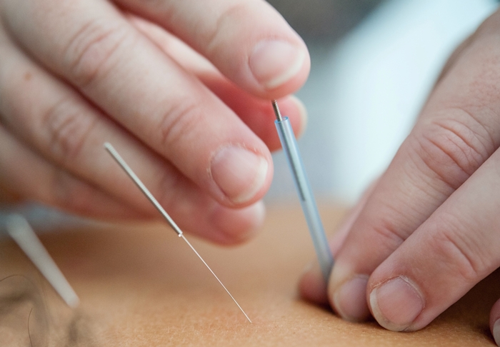 schmerzen im innenmeniskus behandeln akupunktur therapie behandlungsmethoden