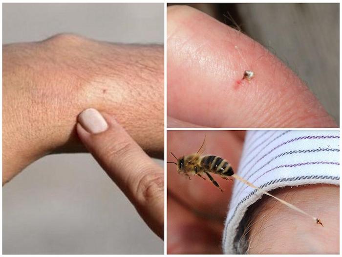 collage mit bildern von wespenstichen wespenstich was tun wichtige informationen und heilmittel selber machen