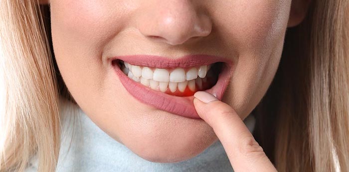 zahnfleischschmerzen hausmittel bei zahnschmerzen zahnschmerzen bei hausmittel was tun bei zahnschmerzen zähne kleinkind frau mit zahnfleischentzündung