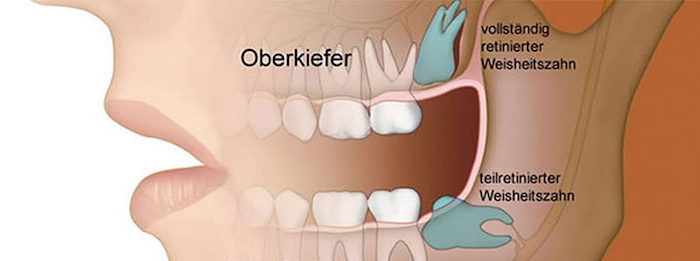 zahnfleischschmerzen starke zahsnchmerzen was tun bei zahnschmerzen entzündungshemmende hausmittel zahnschmerzen tabletten bild vom mund teilen