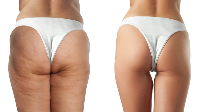 female buttocks before and after treatment anti cellulite massage. cellulite treatment