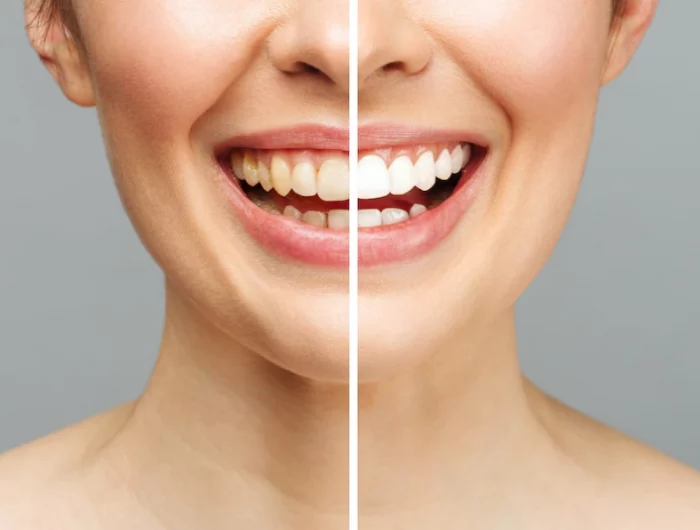 woman teeth before after whitening white background dental clinic patient image symbolizes oral care dentistry stomatology 168410 1716
