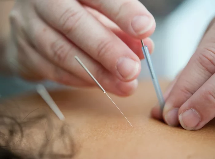 akupunktur bei verspannungen im ruecken