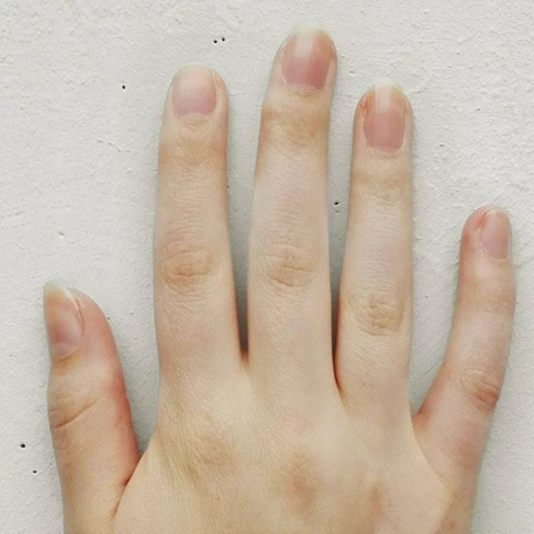 welche krankheiten sieht man an den fingernaegeln blasse haende