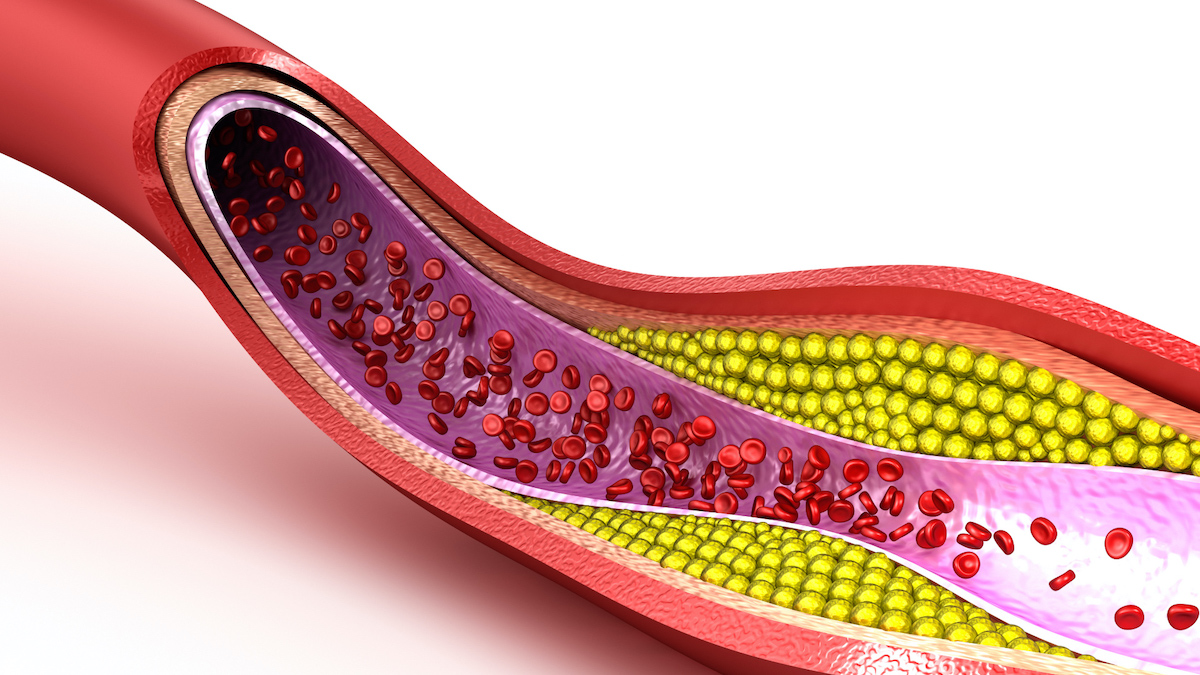 erhoehte cholesterinwerte ab 60 bei frauen was ist zu tun