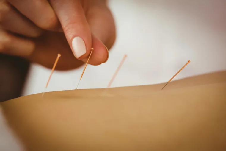 natürliche wundermittel gegen ischias ausprobieren akupunktur