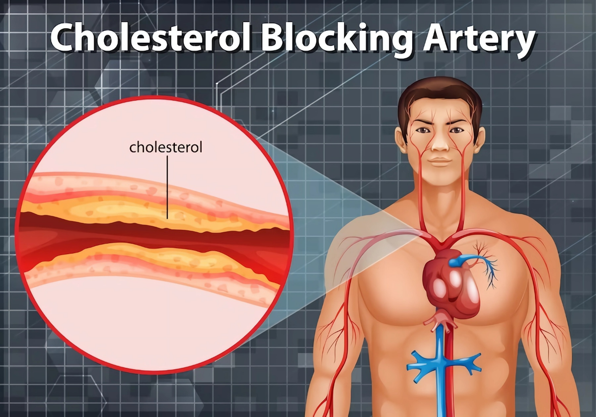 was passiert bei zu hohem cholesterin