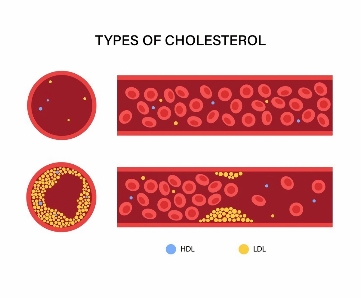 zu hohe cholesterinwerte cholesterin blut ablagerungen