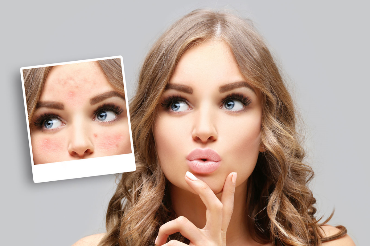 eine frau die unter rosacea leidet und was zu essen