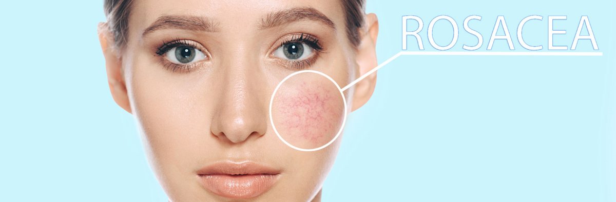 Rosacea Behandlung Tipps Die Ihre Richtige Hautpflege Garantieren