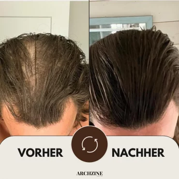 rosmarinöl neue haare vorher nachher