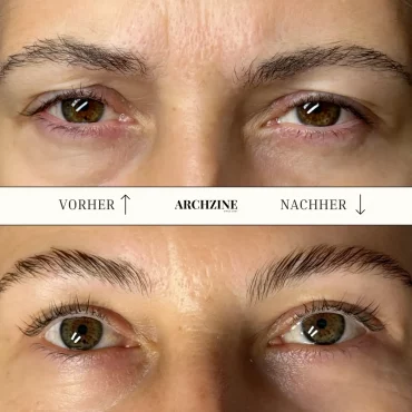 vorher nachher brow lifting