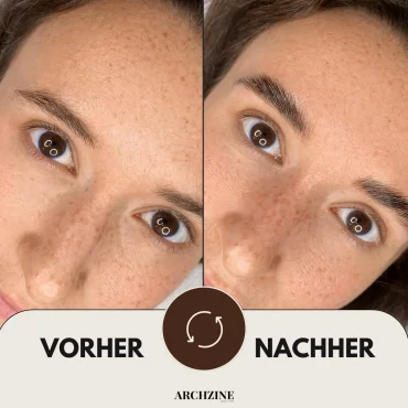 vorher nachher browlifting