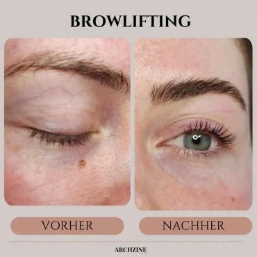 vorher nachher browlifting