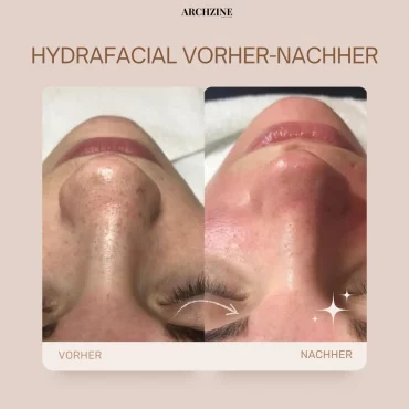 vorher nachher hydrafacial behandlung