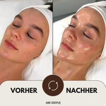 vorher und nachher hydrafacial